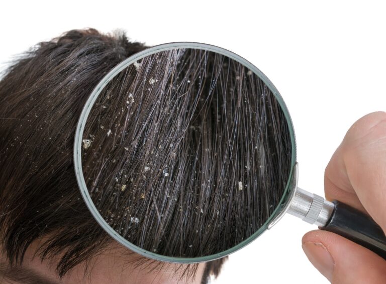 Microbiologist discusses 2024 dandruff care trends and innovations